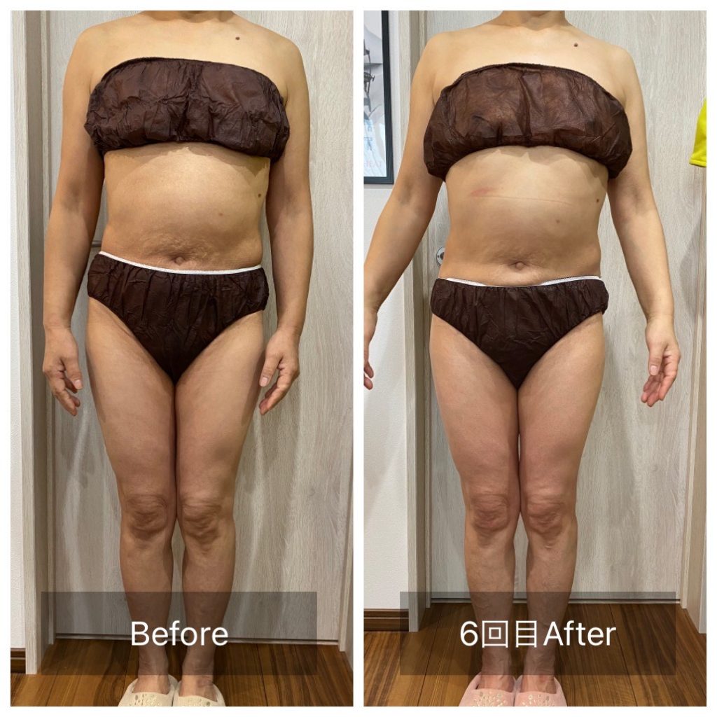 ラジオ波コアヒートで太もものサイズダウン 肌に潤いが出ました エステサロン人気痩身 温活メニューラジオ波コアヒートとは