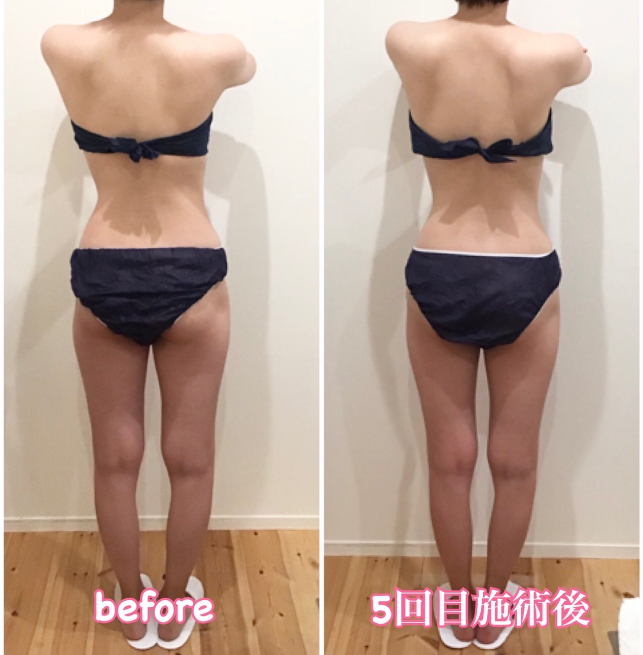 ラジオ波コアヒートでО脚も改善しました！ – エステサロン人気痩身・温