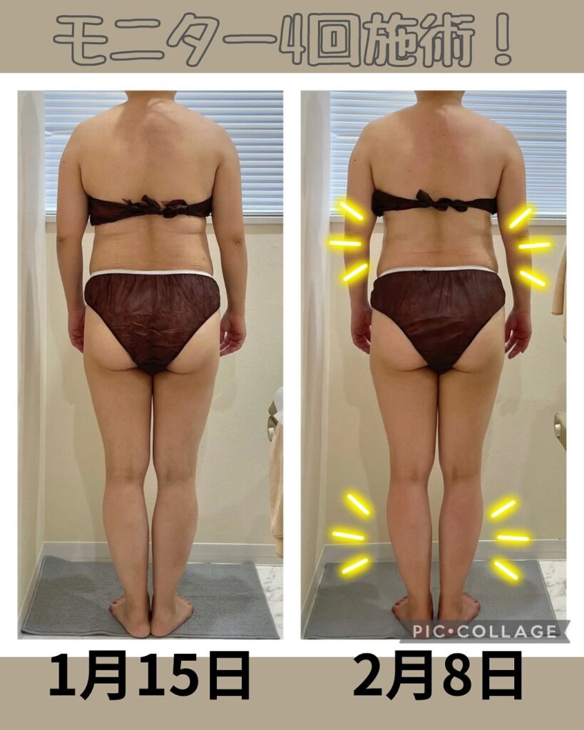 ラジオ波コアヒート痩身のお客様結果写真