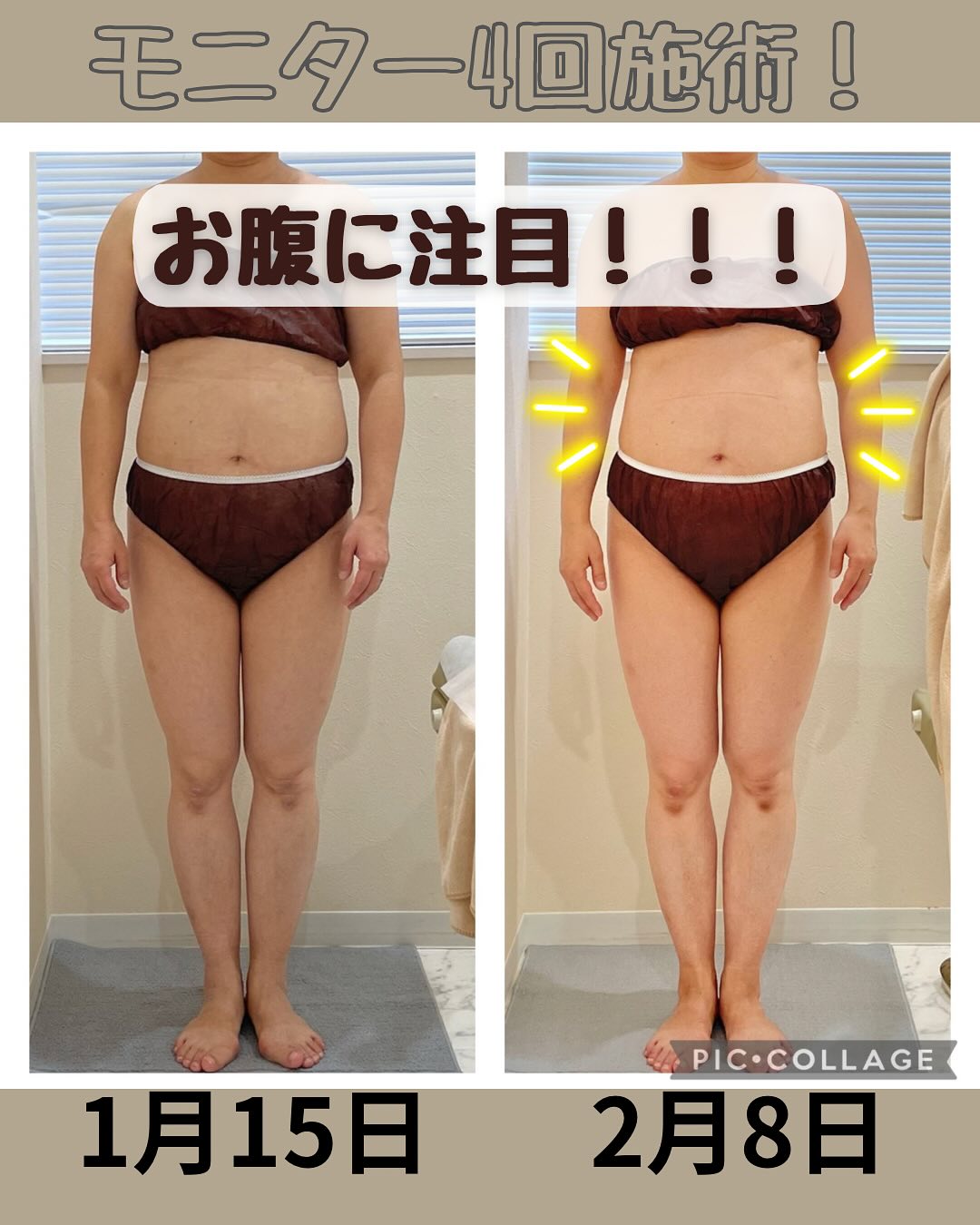 ラジオ波コアヒート痩身のお客様結果写真