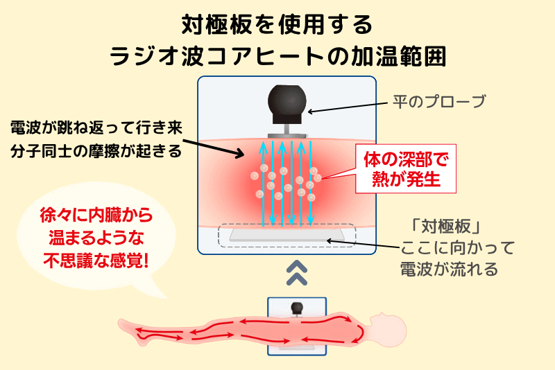 対極板を使用するラジオ波コアヒートの加温範囲