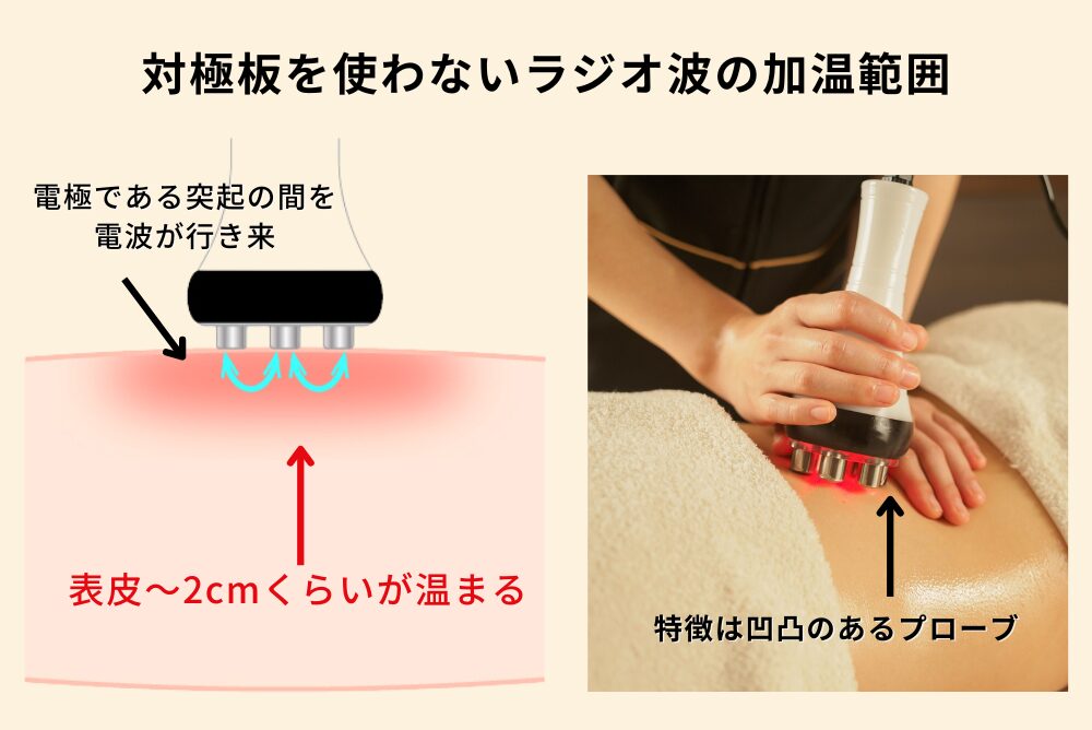 対極板を使わないラジオ波の加温範囲
