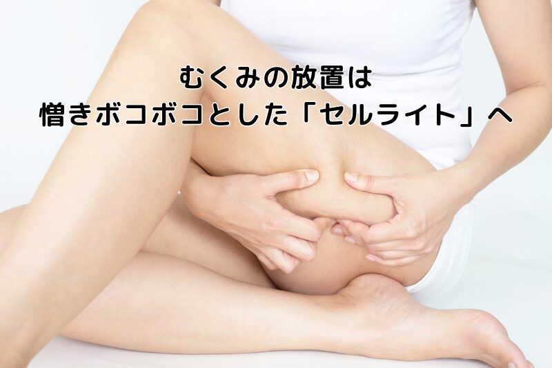 むくみの放置は憎きボコボコとした「セルライト」