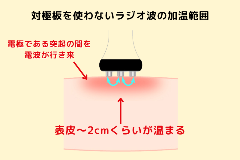 対極板を使用しないラジオ波の加温範囲