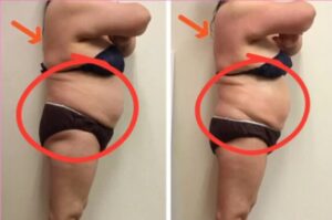 ラジオ波コアヒート痩身のお客様結果写真