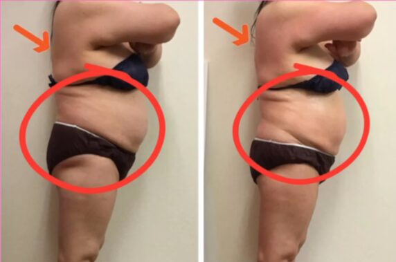 ラジオ波コアヒート痩身のお客様結果写真