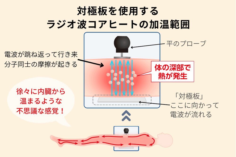 対極板を使用するラジオ波コアヒートの加温範囲