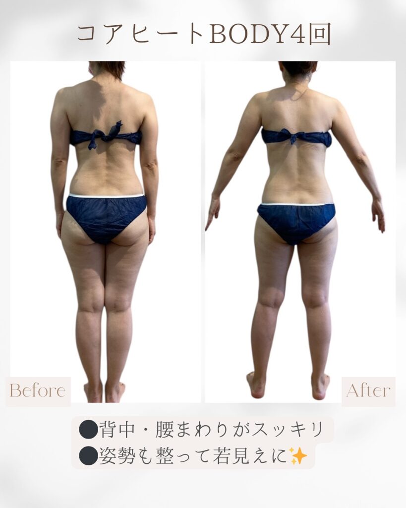 ラジオ波コアヒート痩身のお客様結果写真