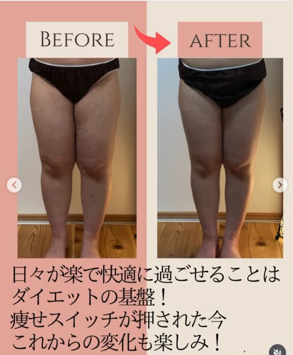 ラジオ波コアヒート痩身のお客様結果写真