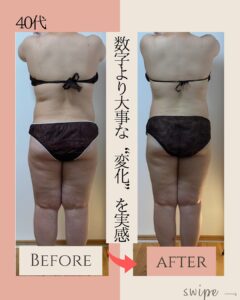 ラジオ波コアヒート痩身のお客様結果写真