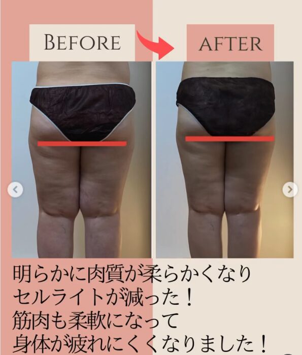 ラジオ波コアヒート痩身のお客様結果写真