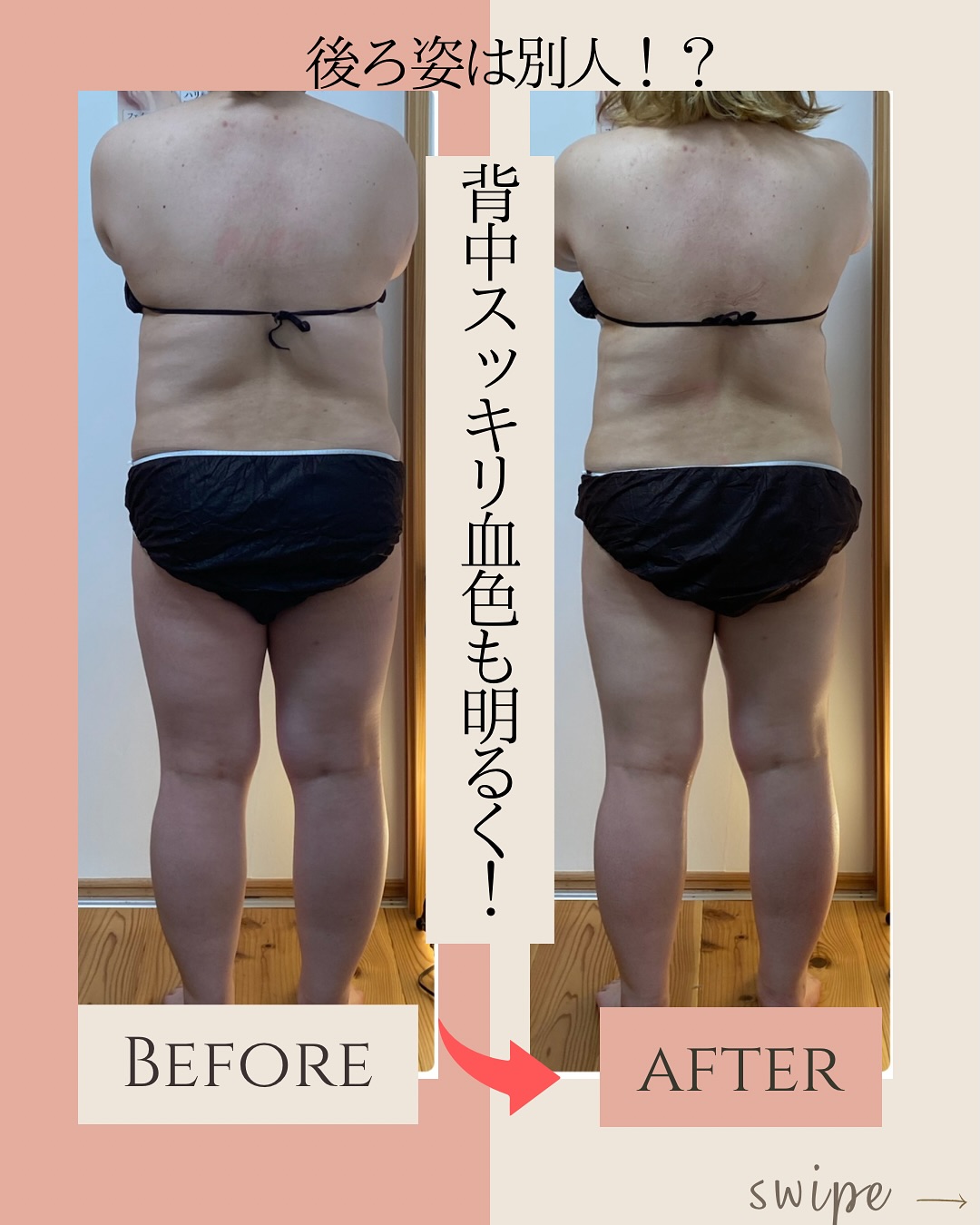 ラジオ波コアヒート痩身のお客様結果写真