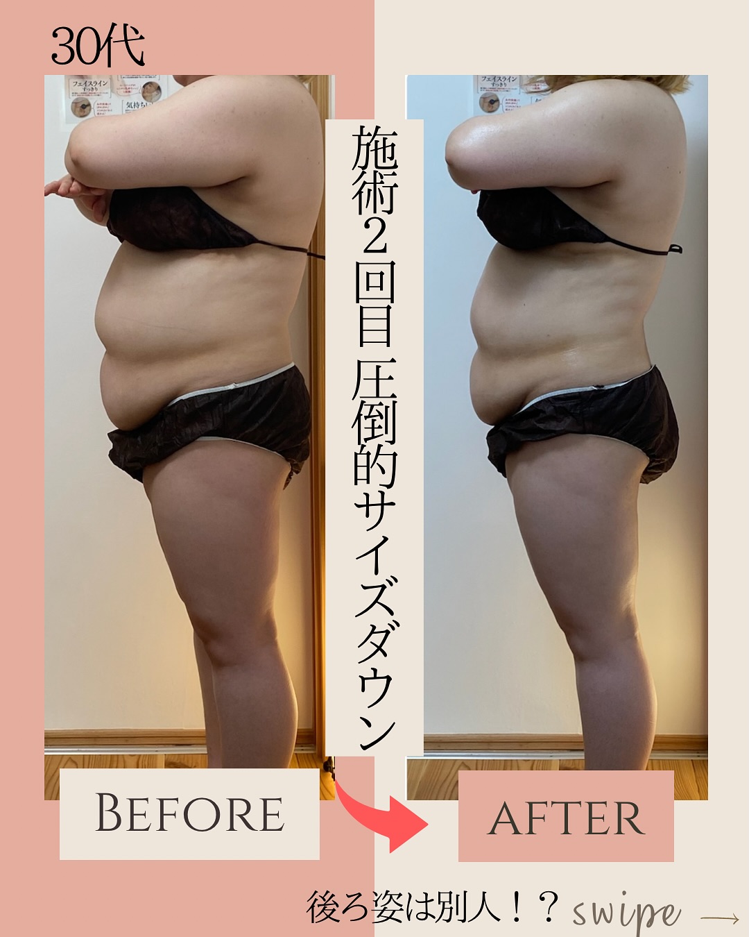 ラジオ波コアヒート痩身のお客様結果写真