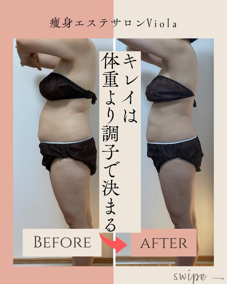 ラジオ波コアヒート痩身のお客様結果写真