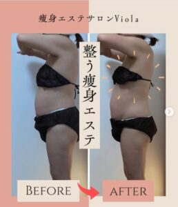 ラジオ波コアヒート痩身のお客様結果写真