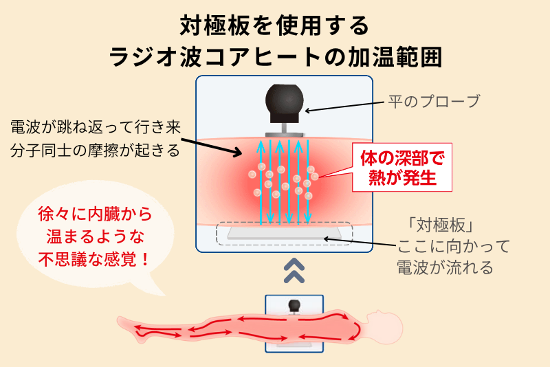 対極板を使用する
ラジオ波コアヒートの加温範囲